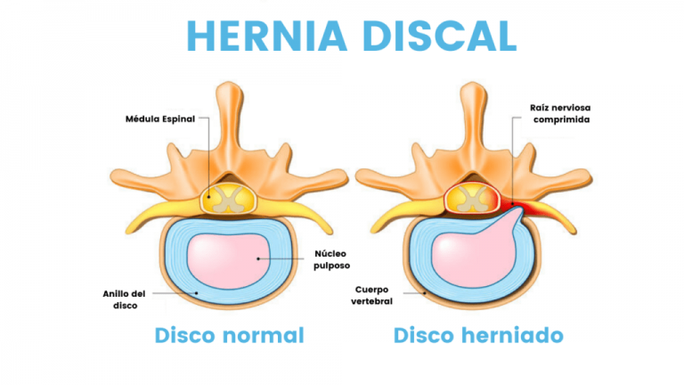 Disco herniado