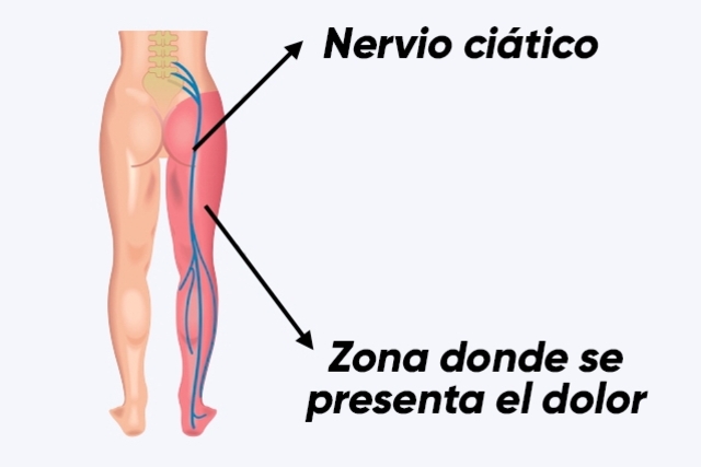 Sindrome piramidal